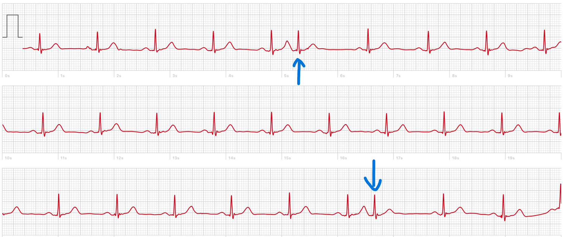 Extra heart beats after ablation